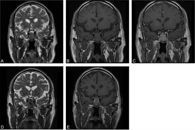 A rare case of pituitary metastasis from hepatocellular carcinoma: case report and literature review